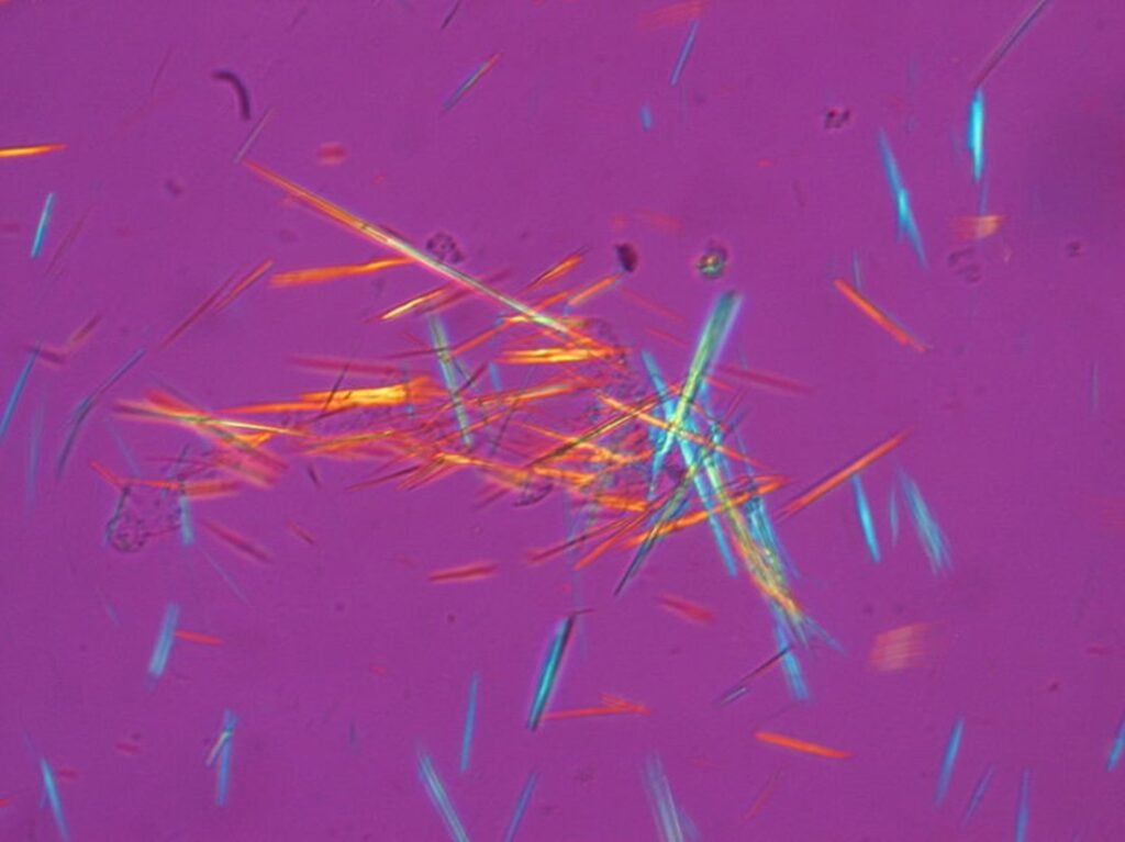 Barras de cristales de urato monosódico fotografiadas bajo luz polarizada a partir de una muestra de líquido sinovial
